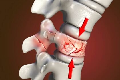 Tips for Avoiding Spine Fracture Complications