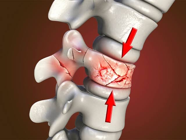 Tips for Avoiding Spine Fracture Complications
