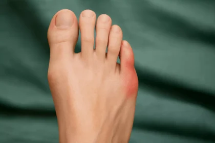 Common Symptoms of Bunions