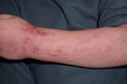 Identifying Allergies in Infants and Young Children
