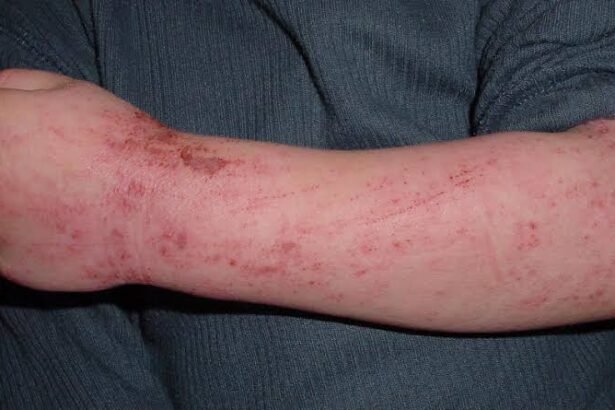 Identifying Allergies in Infants and Young Children