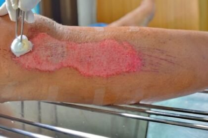 Recognizing When Wound Care Is Necessary