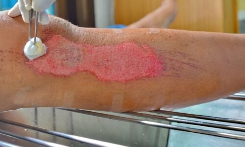 Recognizing When Wound Care Is Necessary