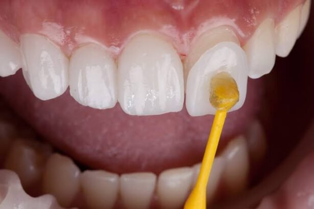 The Role of Veneers in Cosmetic Dentistry