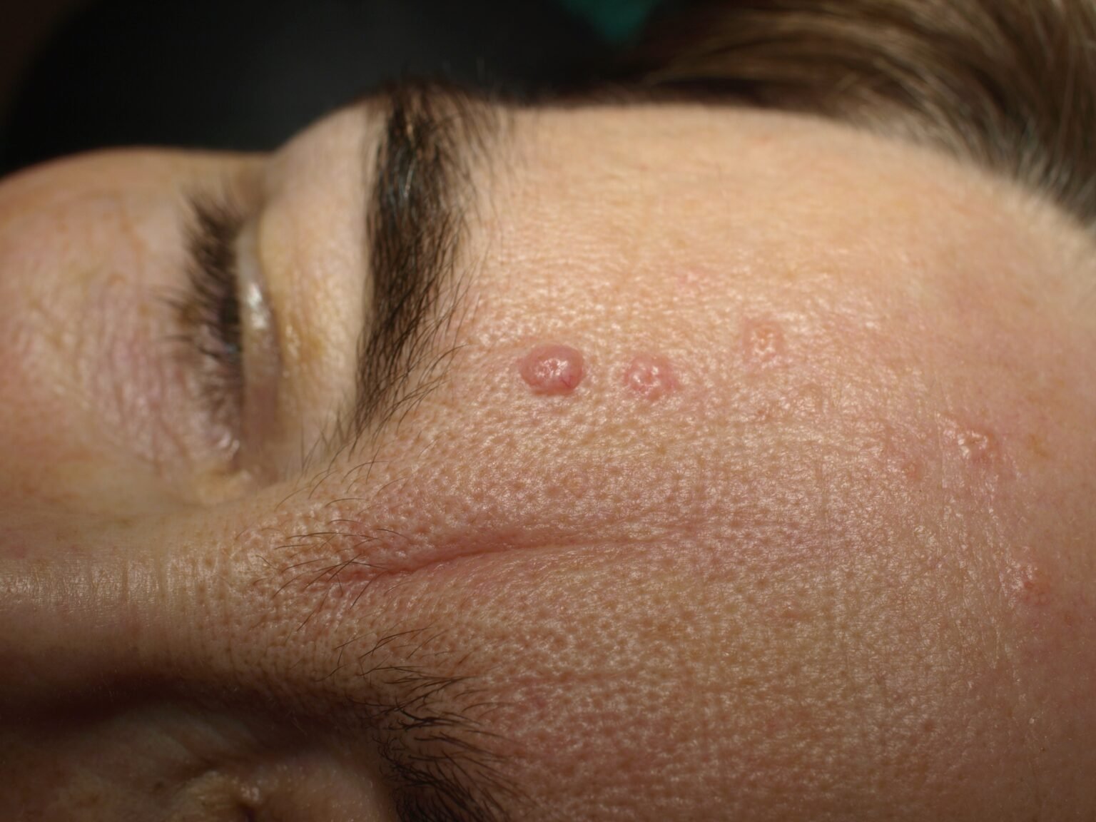 Understanding Seborrheic Keratosis Symptoms and Treatment