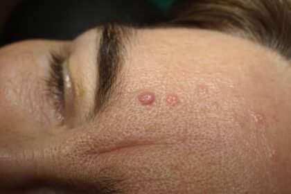 Understanding Seborrheic Keratosis Symptoms and Treatment